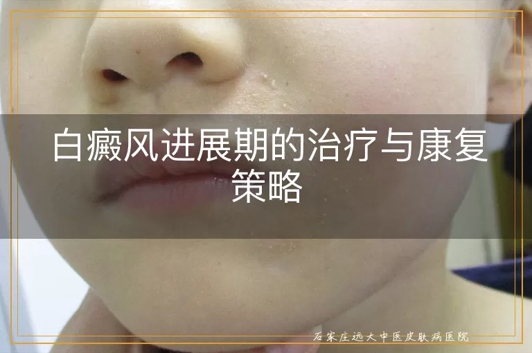 白癜风进展期的治疗与康复策略