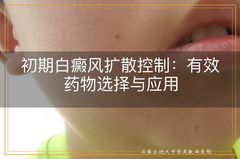 初期白癜风扩散控制：有效药物选择与应用
