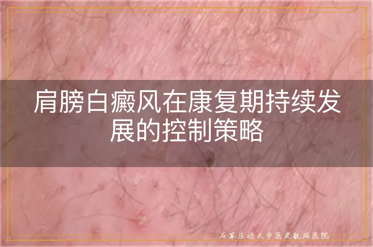 肩膀白癜风在康复期持续发展的控制策略