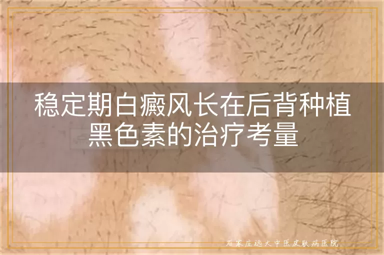 稳定期白癜风长在后背种植黑色素的治疗考量