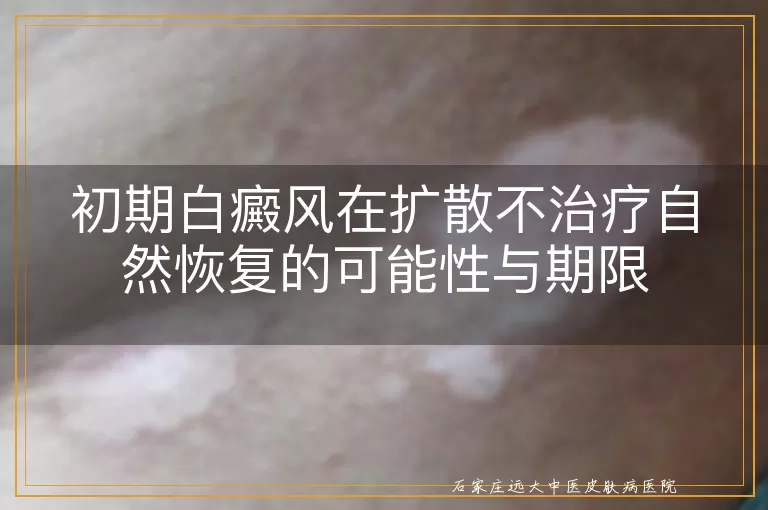 初期白癜风在扩散不治疗自然恢复的可能性与期限