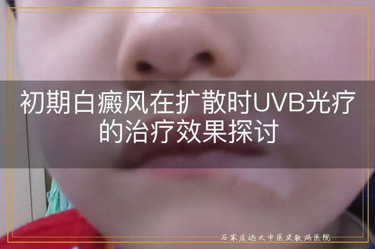 初期白癜风在扩散时UVB光疗的治疗效果探讨