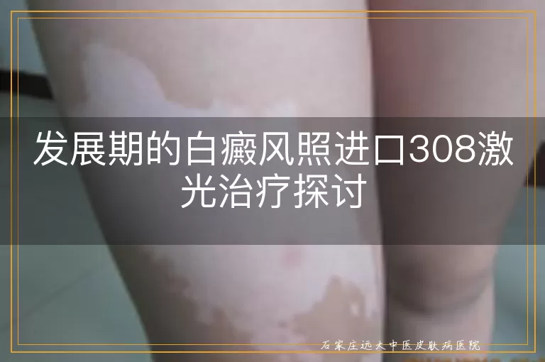 发展期的白癜风照进口308激光治疗探讨