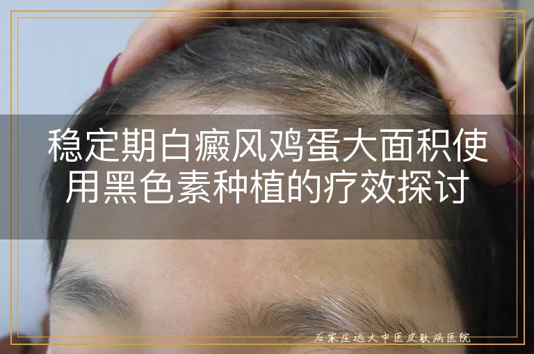 稳定期白癜风鸡蛋大面积使用黑色素种植的疗效探讨