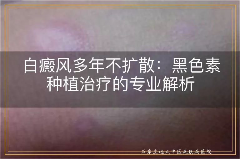 白癜风多年不扩散：黑色素种植治疗的专业解析