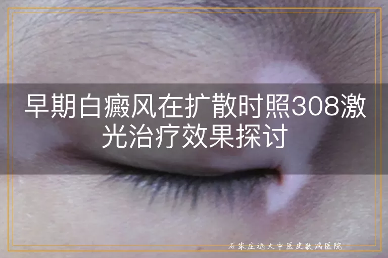 早期白癜风在扩散时照308激光治疗效果探讨