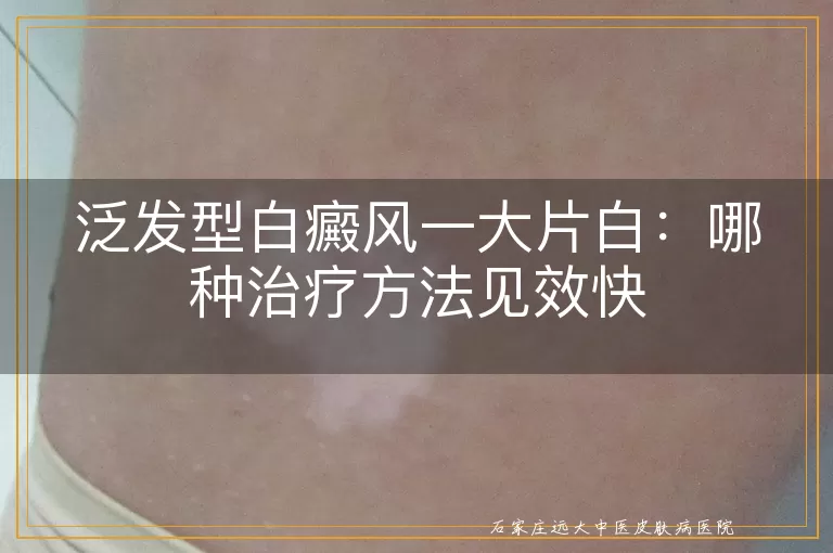 泛发型白癜风一大片白：哪种治疗方法见效快