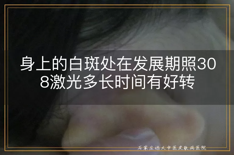 身上的白斑处在发展期照308激光多长时间有好转