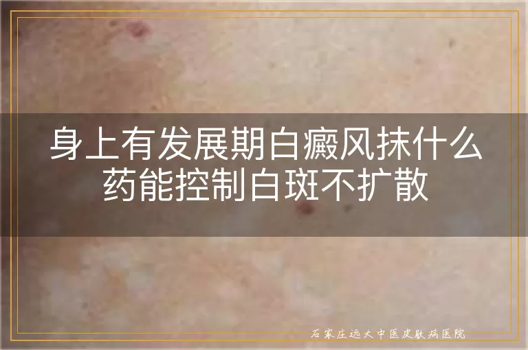 身上有发展期白癜风抹什么药能控制白斑不扩散