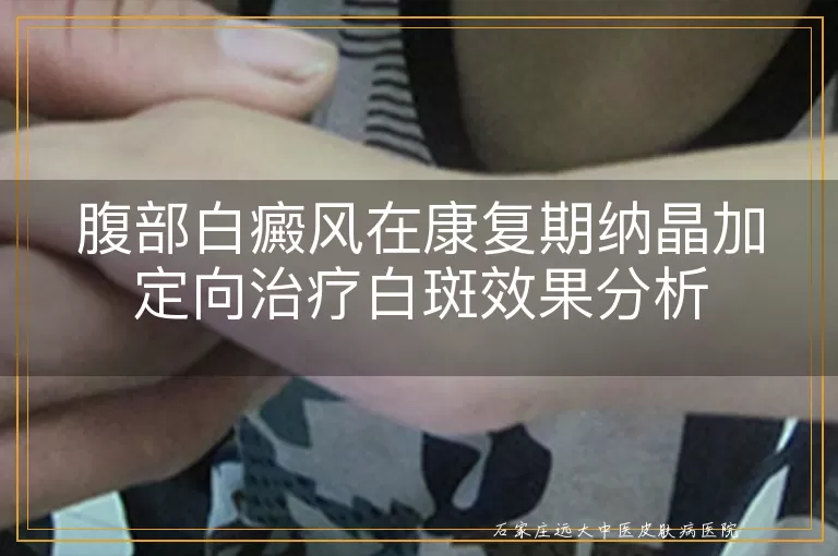 腹部白癜风在康复期纳晶加定向治疗白斑效果分析