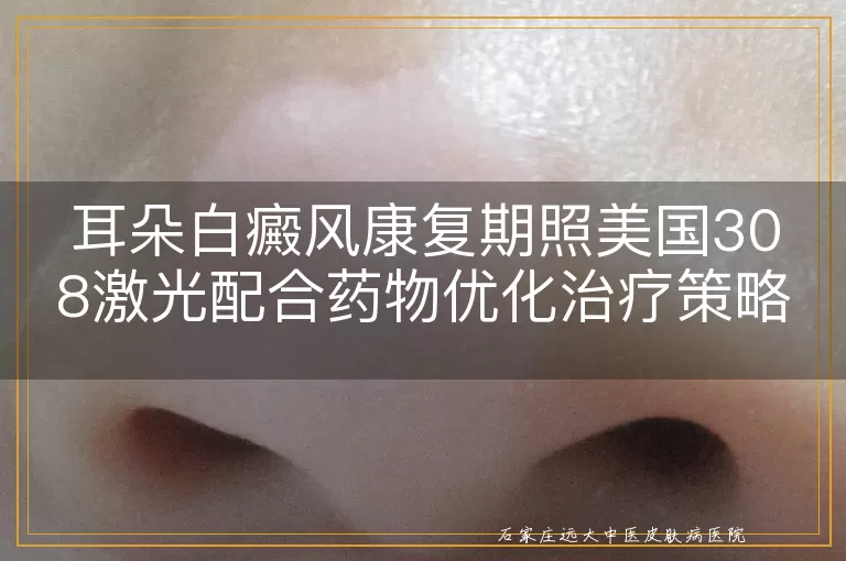 耳朵白癜风康复期照美国308激光配合药物优化治疗策略