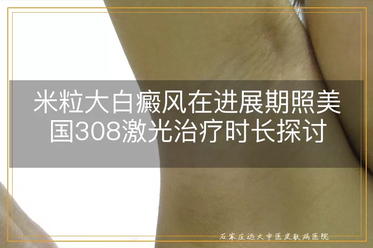 米粒大白癜风在进展期照美国308激光治疗时长探讨