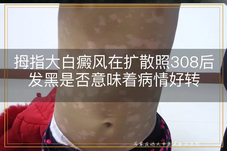 拇指大白癜风在扩散照308后发黑是否意味着病情好转