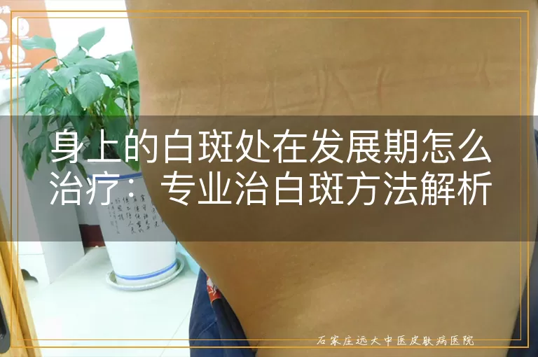 身上的白斑处在发展期怎么治疗：专业治白斑方法解析