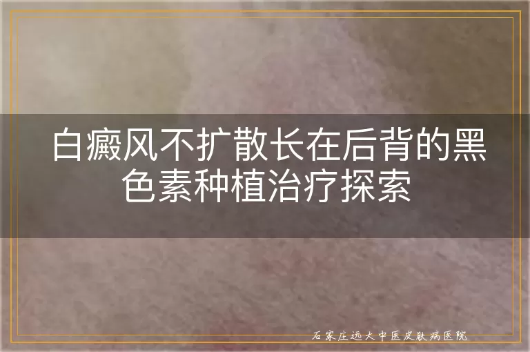 白癜风不扩散长在后背的黑色素种植治疗探索