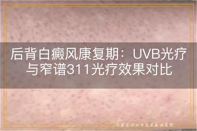 后背白癜风康复期：UVB光疗与窄谱311光疗效果对比