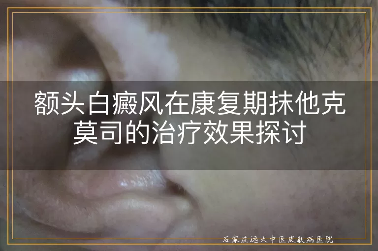 额头白癜风在康复期抹他克莫司的治疗效果探讨