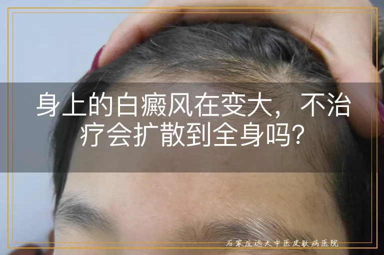身上的白癜风在变大，不治疗会扩散到全身吗？