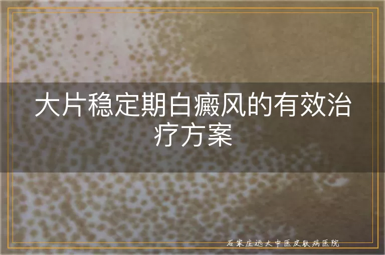 大片稳定期白癜风的有效治疗方案
