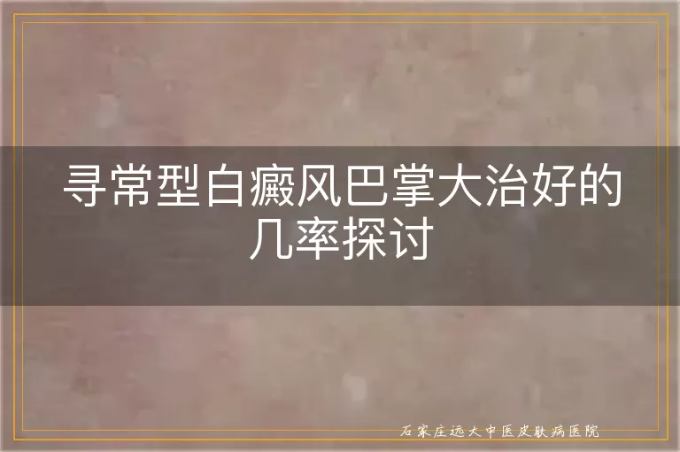 寻常型白癜风巴掌大治好的几率探讨