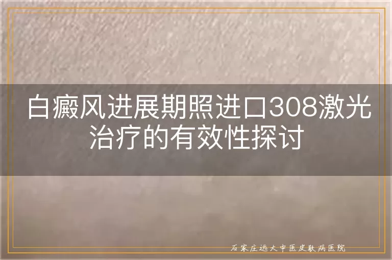 白癜风进展期照进口308激光治疗的有效性探讨