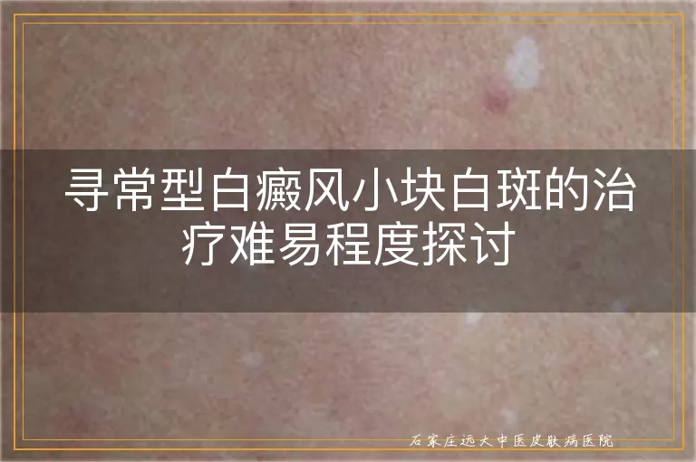 寻常型白癜风小块白斑的治疗难易程度探讨