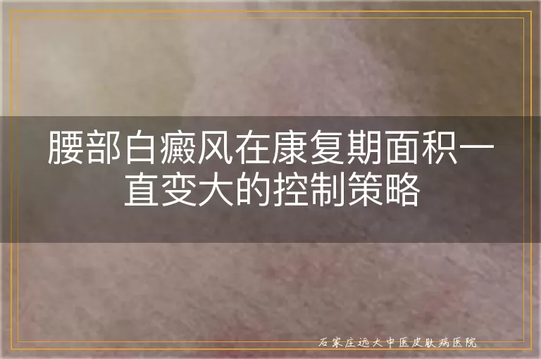腰部白癜风在康复期面积一直变大的控制策略