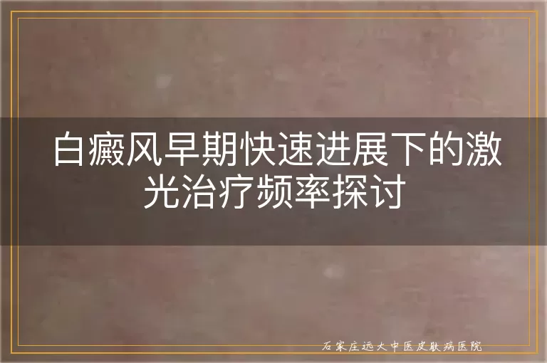 白癜风早期快速进展下的激光治疗频率探讨