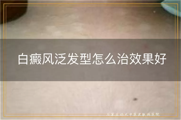 白癜风泛发型怎么治效果好