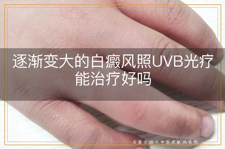 逐渐变大的白癜风照UVB光疗能治疗好吗