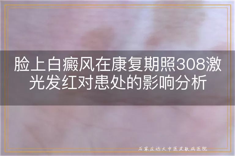 脸上白癜风在康复期照308激光发红对患处的影响分析