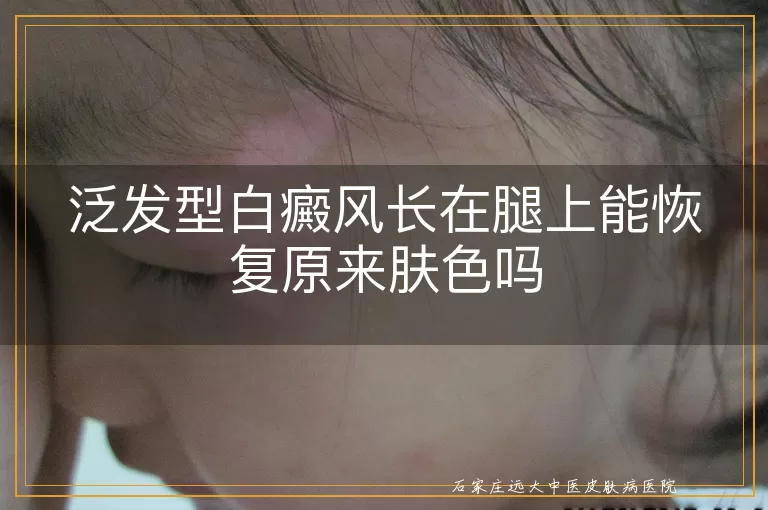 泛发型白癜风长在腿上能恢复原来肤色吗