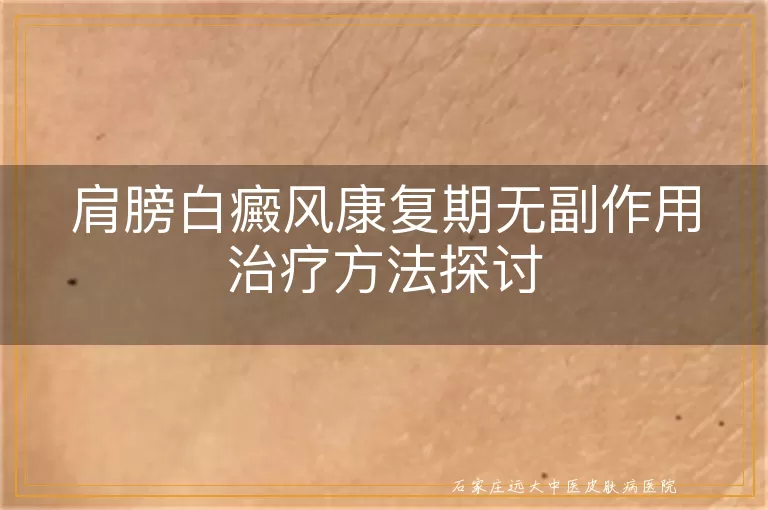 肩膀白癜风康复期无副作用治疗方法探讨