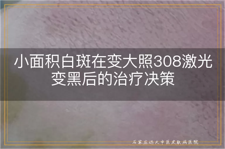 小面积白斑在变大照308激光变黑后的治疗决策