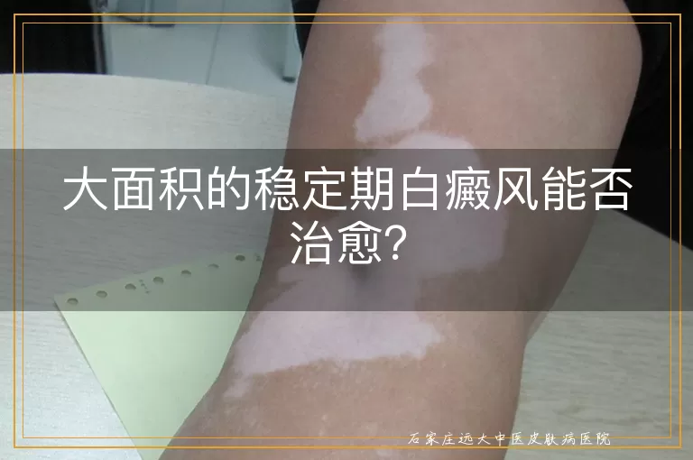 大面积的稳定期白癜风能否治愈？