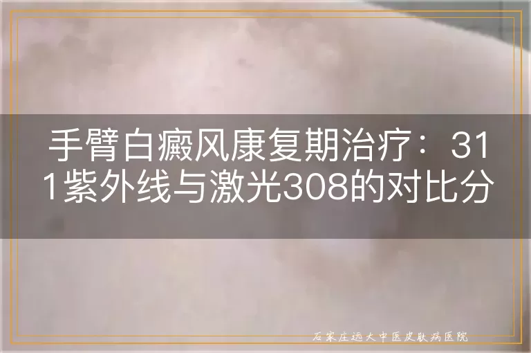 手臂白癜风康复期治疗：311紫外线与激光308的对比分析