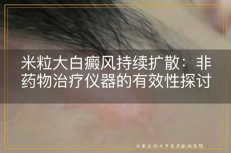 米粒大白癜风持续扩散：非药物治疗仪器的有效性探讨