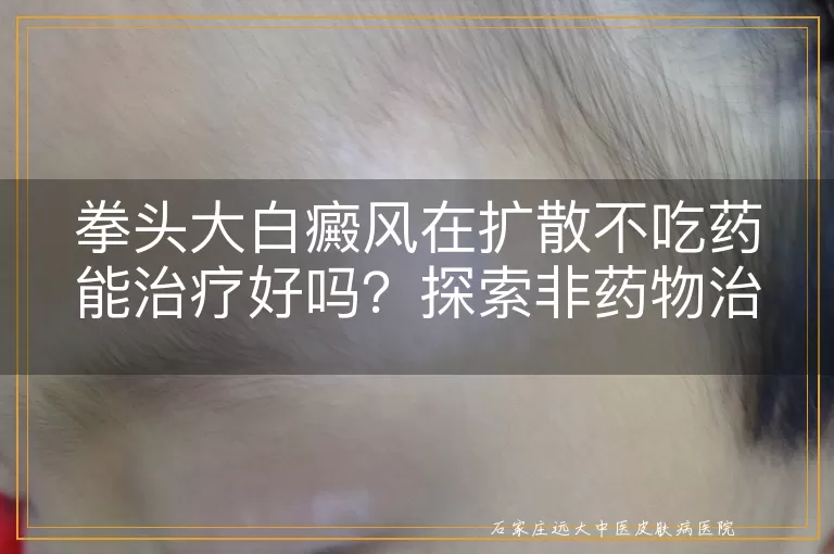 拳头大白癜风在扩散不吃药能治疗好吗？探索非药物治疗仪器选项