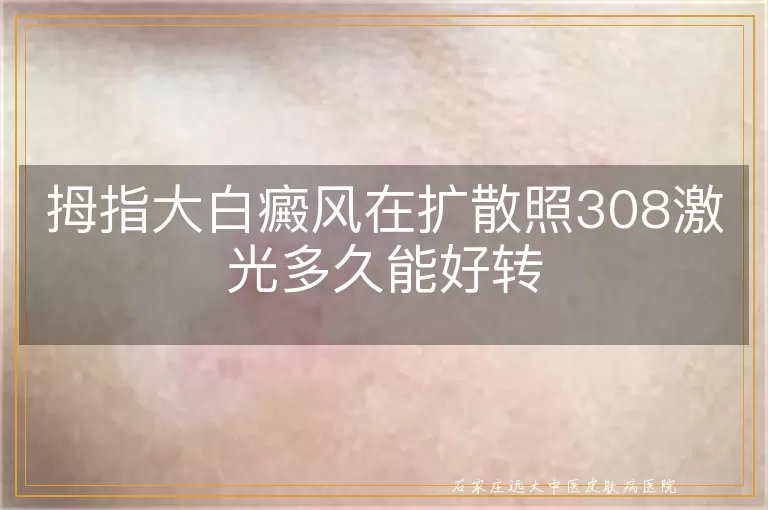 拇指大白癜风在扩散照308激光多久能好转