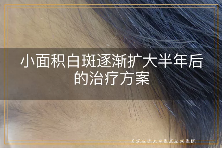 小面积白斑逐渐扩大半年后的治疗方案