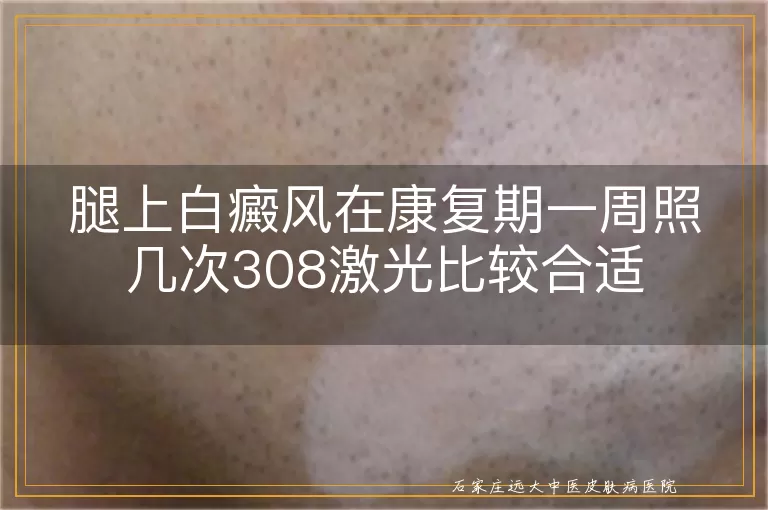 腿上白癜风在康复期一周照几次308激光比较合适