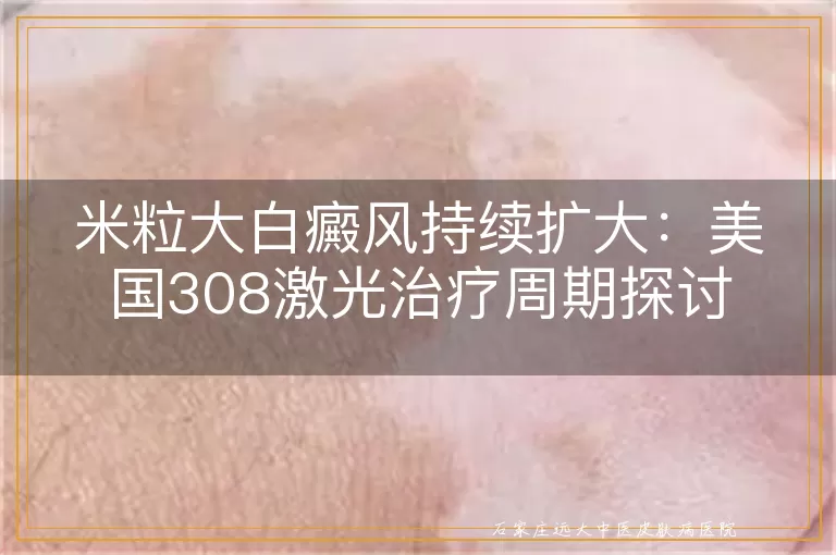 米粒大白癜风持续扩大：美国308激光治疗周期探讨