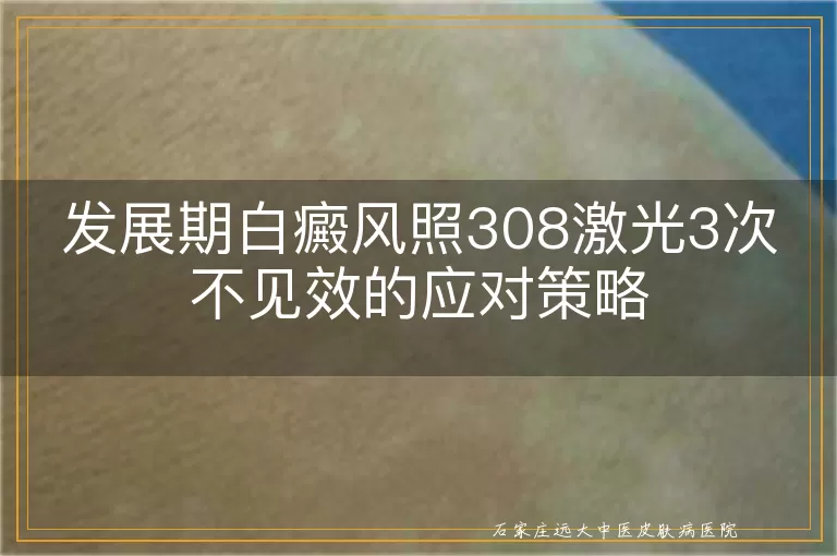 发展期白癜风照308激光3次不见效的应对策略