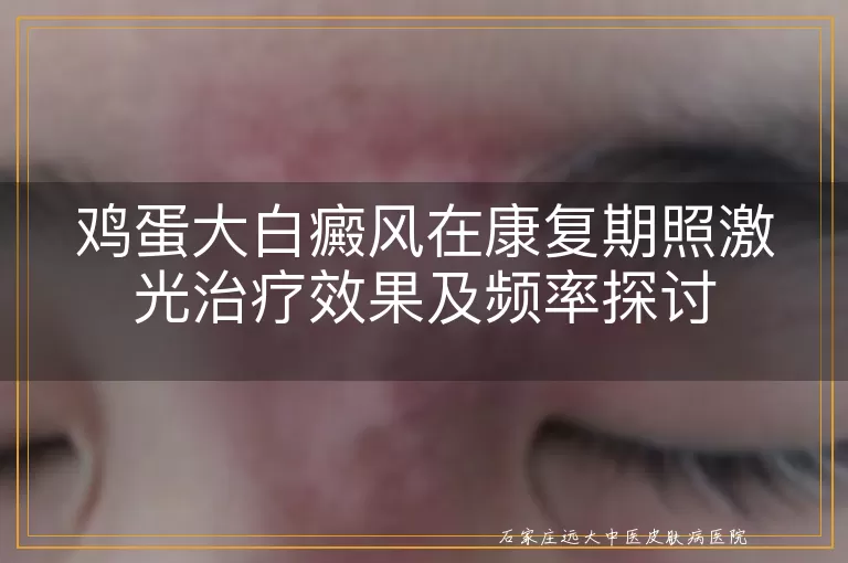 鸡蛋大白癜风在康复期照激光治疗效果及频率探讨