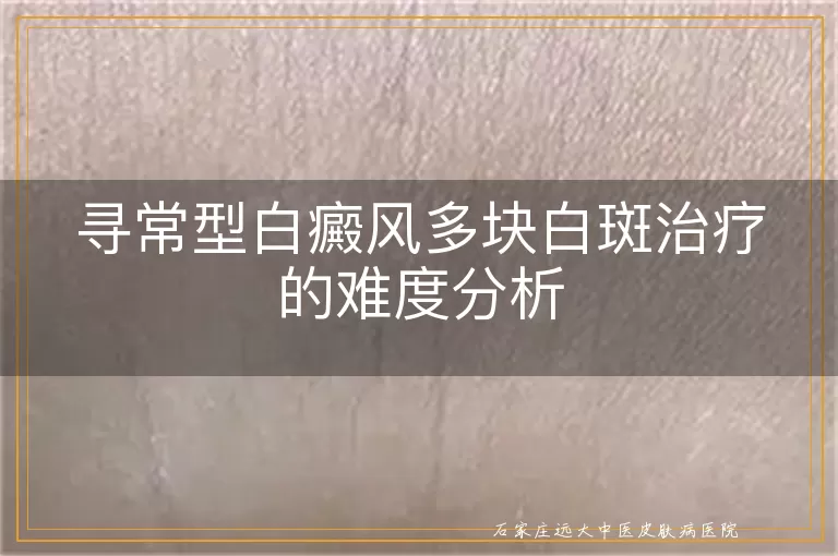 寻常型白癜风多块白斑治疗的难度分析