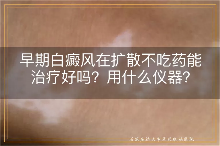 早期白癜风在扩散不吃药能治疗好吗？用什么仪器？