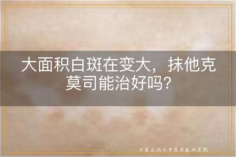 大面积白斑在变大，抹他克莫司能治好吗？