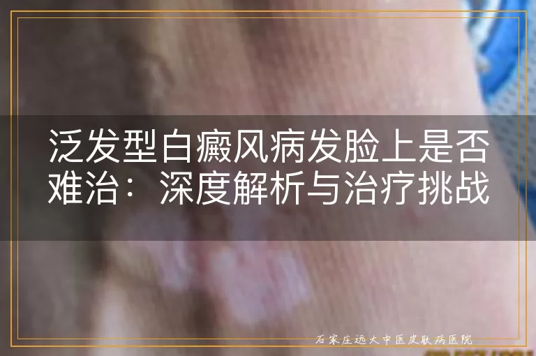 泛发型白癜风病发脸上是否难治：深度解析与治疗挑战