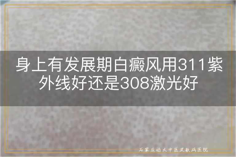 身上有发展期白癜风用311紫外线好还是308激光好