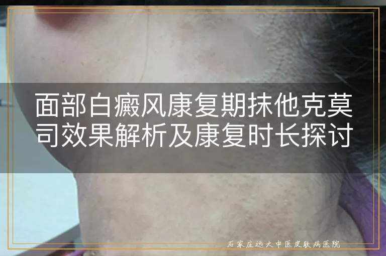 面部白癜风康复期抹他克莫司效果解析及康复时长探讨